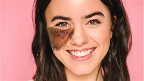 Living with birthmarks: What are the ones you can and cannot .